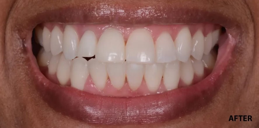 After treatment photo