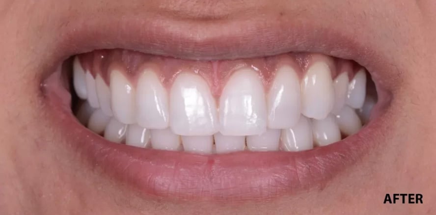 After treatment photo