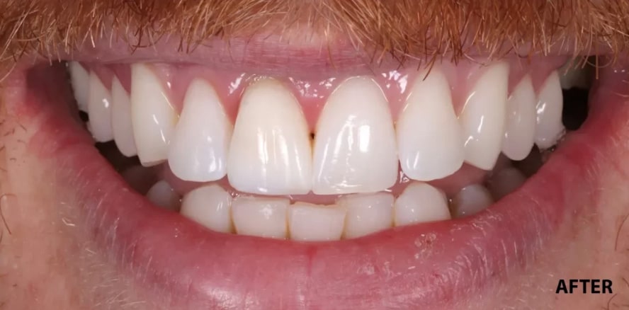 After treatment photo