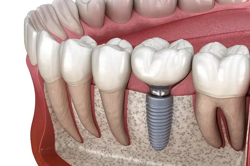 Dental Implant