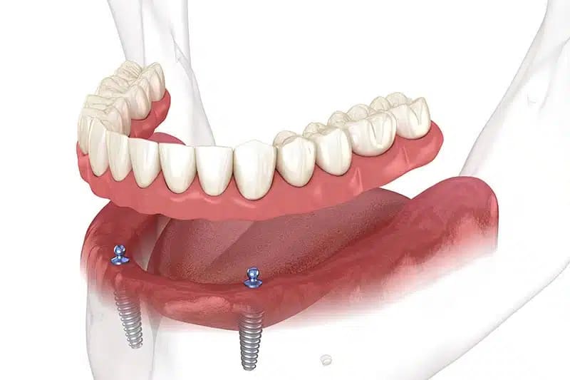 Full Mouth Implant