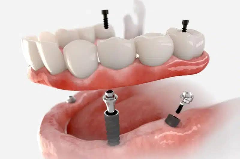 Full Mouth Implant