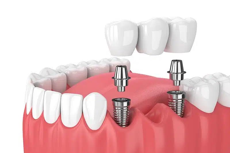 Dental Multiple Implant